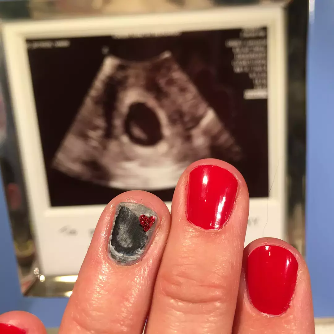 Ultrasound Nail Art